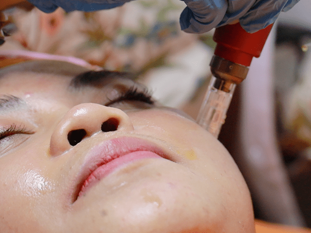 Cara Menghilangkan Melasma di Wajah