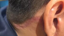 Pasien berinisial EV asal Surabaya, Jawa Timur, mengaku mengalami malpraktik dari operasi tarik wajah oleh dokter Song Hyungmin. (Foto: Istimewa)