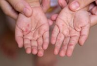 Kementerian Kesehatan mendorong imunisasi MR lengkap untuk anak sebagai langkah utama mencegah penularan campak menjelang mudik Lebaran. (Foto: Freepik)