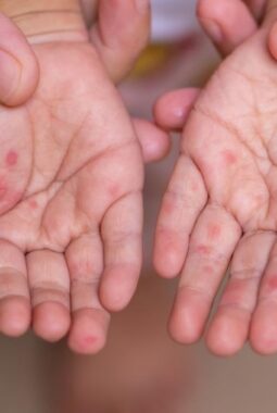 Lonjakan Mobilitas Lebaran Picu Risiko Campak, Imunisasi Anak Jadi Kunci