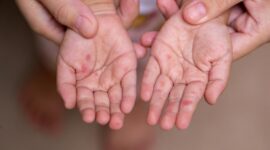 Kementerian Kesehatan mendorong imunisasi MR lengkap untuk anak sebagai langkah utama mencegah penularan campak menjelang mudik Lebaran. (Foto: Freepik)