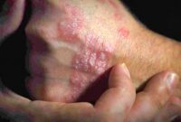 Melawan kusta bukan hanya soal pengobatan, tetapi juga menghapus stigma yang membuat penderita terlambat mencari pertolongan.(Foto: Freepik)