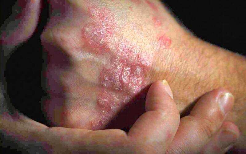 Melawan kusta bukan hanya soal pengobatan, tetapi juga menghapus stigma yang membuat penderita terlambat mencari pertolongan.(Foto: Freepik)