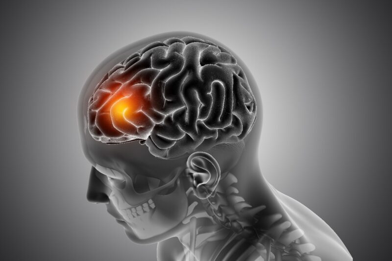 Deteksi lebih awal menjadi kunci menahan stroke sebelum merenggut kualitas hidup. (Foto: Freepik)