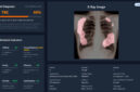 Teknologi AI dikembangkan untuk membantu mempercepat deteksi TBC hingga menjangkau wilayah terpencil dan kelompok rentan. (Foto: TBScreen.AI Research Team/UGM)