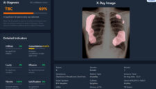Teknologi AI dikembangkan untuk membantu mempercepat deteksi TBC hingga menjangkau wilayah terpencil dan kelompok rentan. (Foto: TBScreen.AI Research Team/UGM)