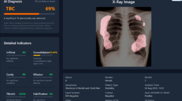 Teknologi AI dikembangkan untuk membantu mempercepat deteksi TBC hingga menjangkau wilayah terpencil dan kelompok rentan. (Foto: TBScreen.AI Research Team/UGM)