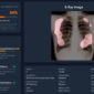 Teknologi AI dikembangkan untuk membantu mempercepat deteksi TBC hingga menjangkau wilayah terpencil dan kelompok rentan. (Foto: TBScreen.AI Research Team/UGM)